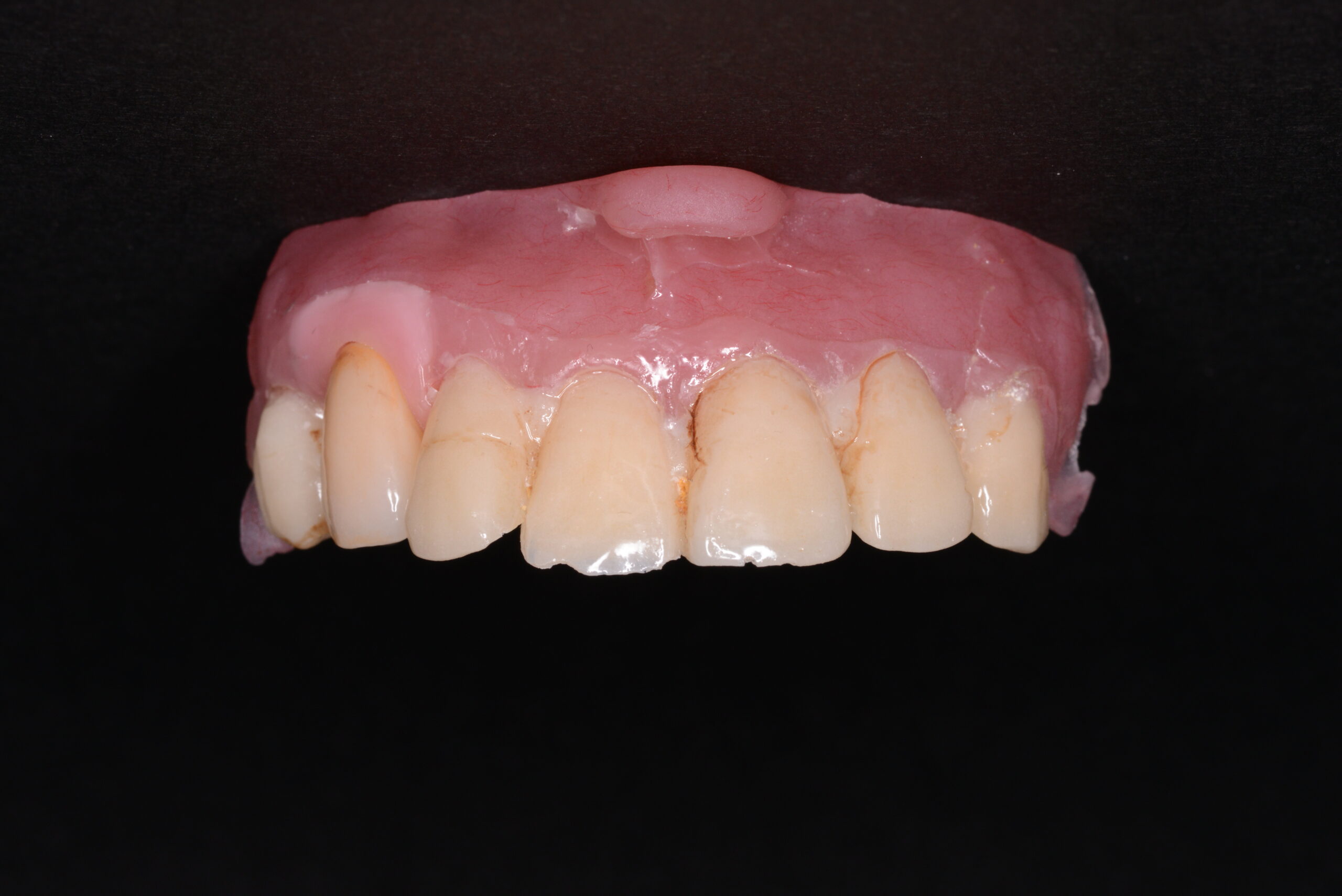 セラミック治療のご紹介 ～「かぶせができるまで」編～ - 【大森歯科