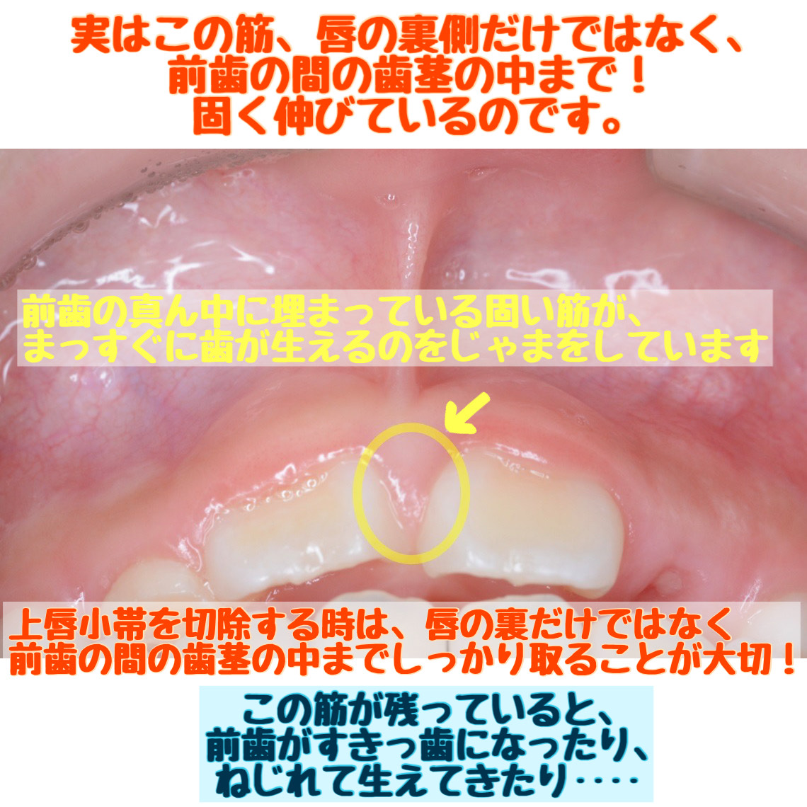 上唇の裏の筋が長く突っ張っている方(上唇小帯高位付着)の治療について - 【大森歯科医院|岡山県総社市の歯科医院です】