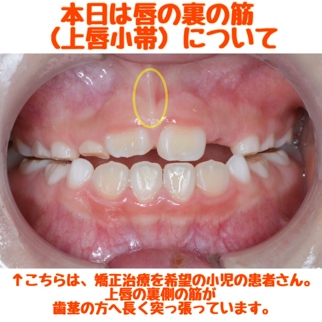 上唇の裏の筋が長く突っ張っている方(上唇小帯高位付着)の治療について - 【大森歯科医院|岡山県総社市の歯科医院です】